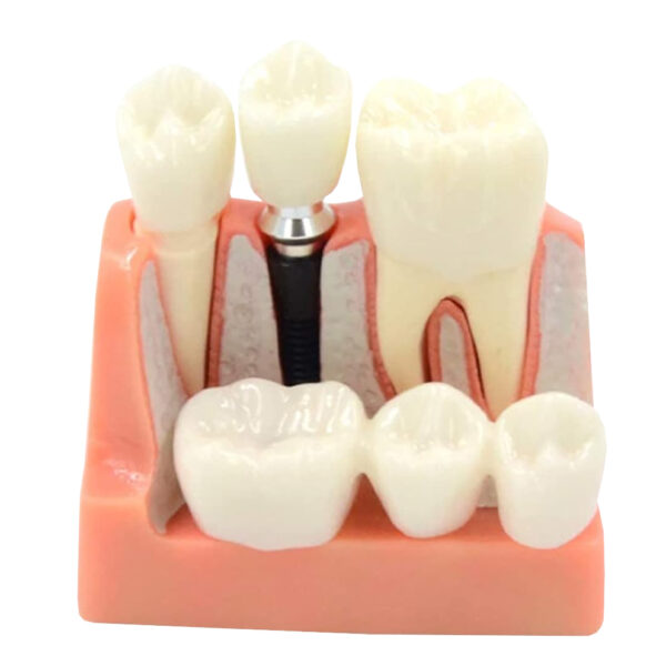 Model implantu dentystycznego jamy ustnej model zębów - obrazek 2